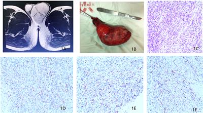 Case Report: Paratesticular Rhabdomyosarcoma